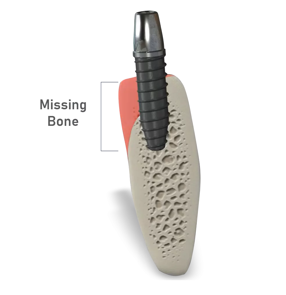 bone grafting