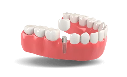dental implants photo